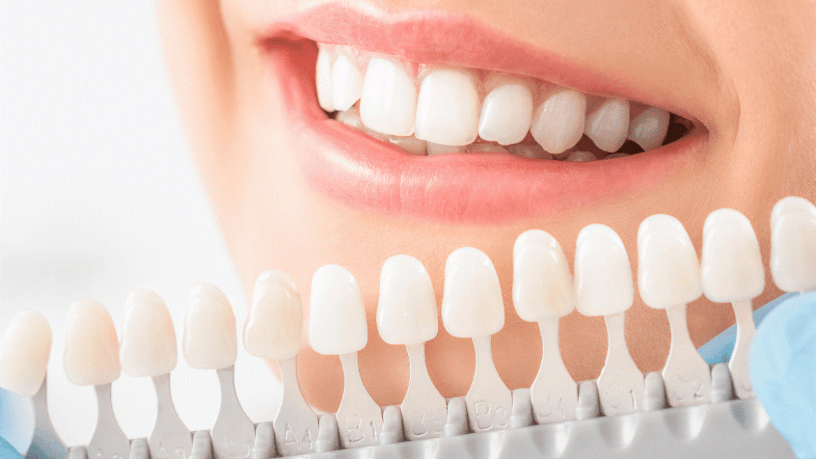 Dental Implants vs. Crowns: Which Option Is Best for You?