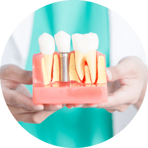 Dental Implants