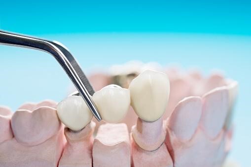 Teeth whitening1