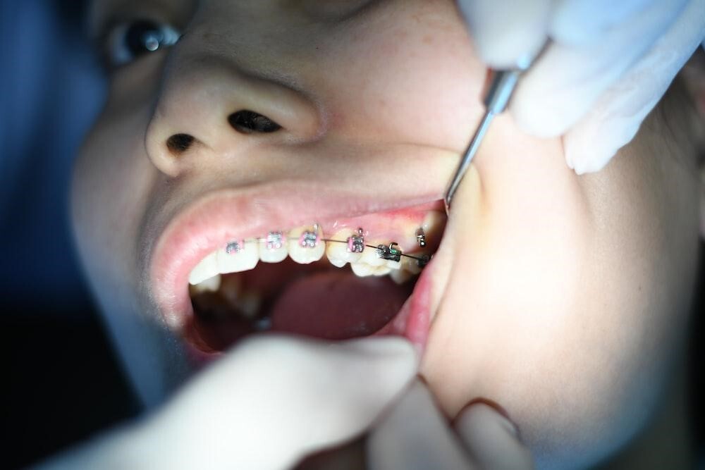 Veneers