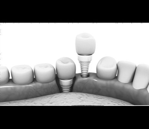 What are Dental Implants?