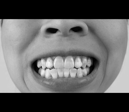 What are those white spots I see after braces?