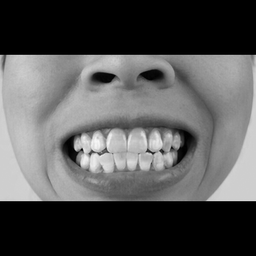 What are those white spots I see after braces?