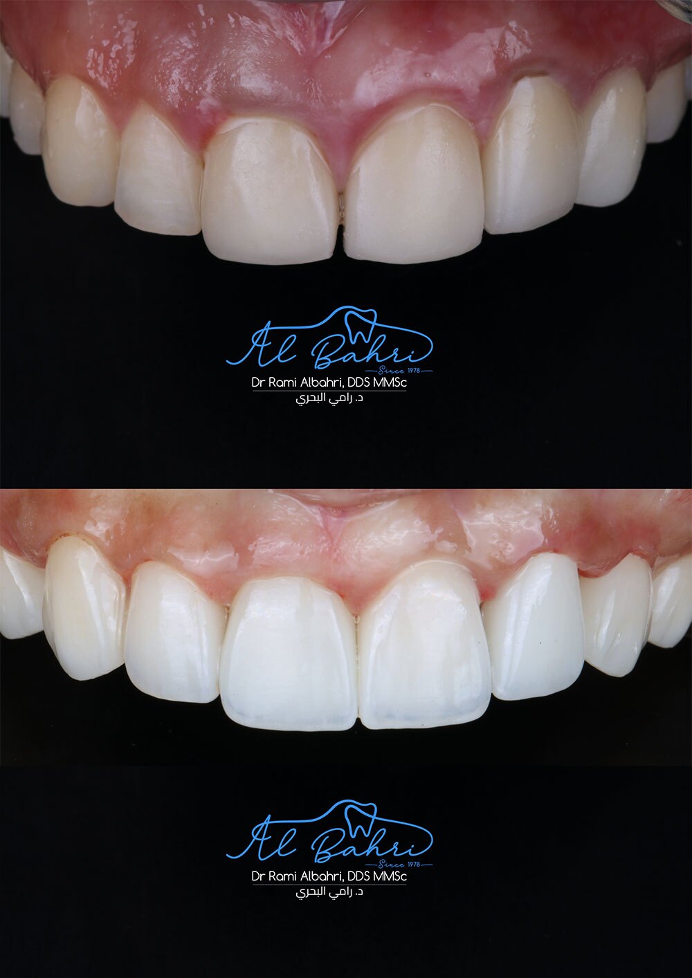 Dental-Teeth-Whitening