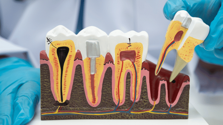 How to Protect Your Tooth After a Root Canal