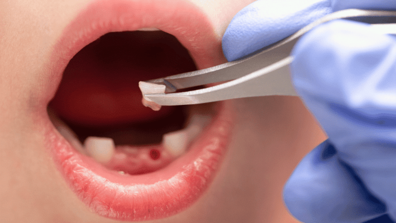 What to Do When Your Child Knocks Out a Tooth: Immediate Steps and Care Tips