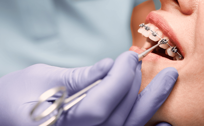 The Essential Checklist for Selecting an Orthodontist for Braces: What to Look For