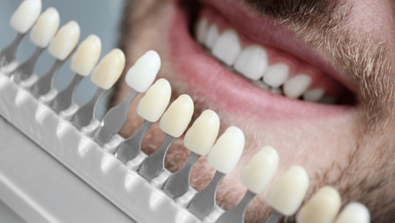 Can You Whiten Crowns, Veneers, or Fillings?