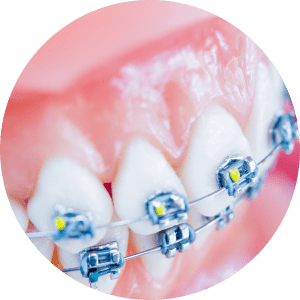 Orthodontist Service In Al Ain