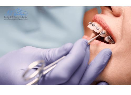 Orthodontist in Al Ain - Albahri Dental