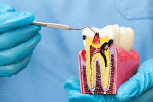 Patient receiving root canal restoration and dental implant consultation in Abu Dhabi